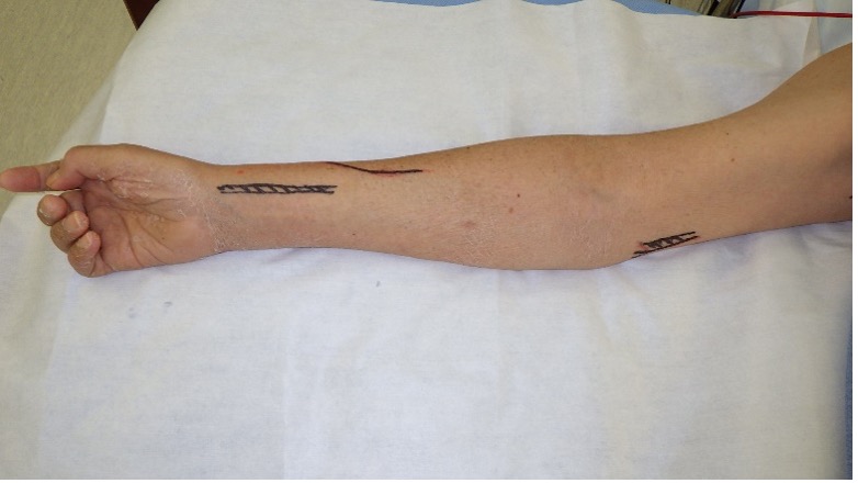 Figure 1. Preoperative markings. Marking of the radial artery and the large cutaneous vein (basilic vein, Case 3) is performed. 