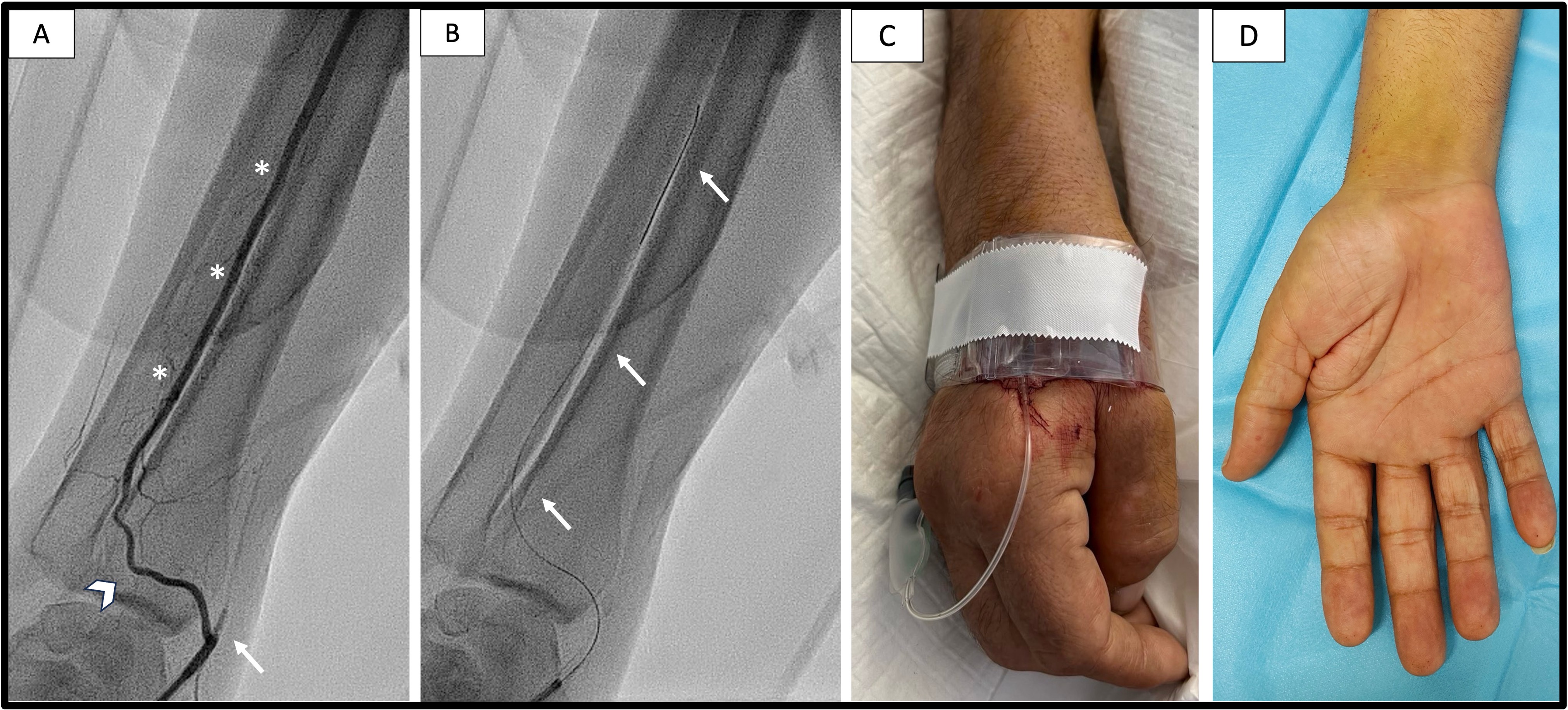 Figure. (A) Occluded radial artery 