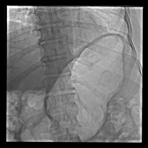 Figure 1. Fluoroscopic image showing gastric dilatation.