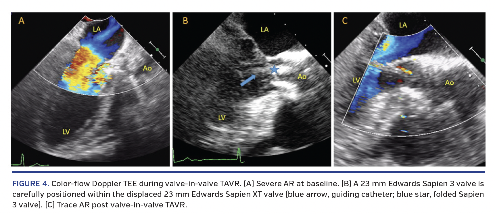 FIGURE 4. Color-flow Doppler TEE during valve-in-valve TAVR. (A) Severe AR at baseline. (B) A 23 mm Edwards Sapien 3 valve is carefully positioned within the displaced 23 mm Edwards Sapien XT valve (blue arrow, guiding catheter; blue star, folded Sapien 3 valve). (C) Trace AR post valve-in-valve TAVR.