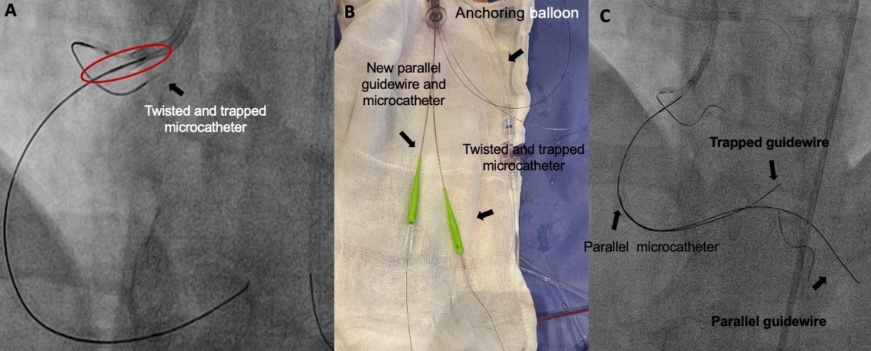 Figure 2. (A) The guidewire was retracted 