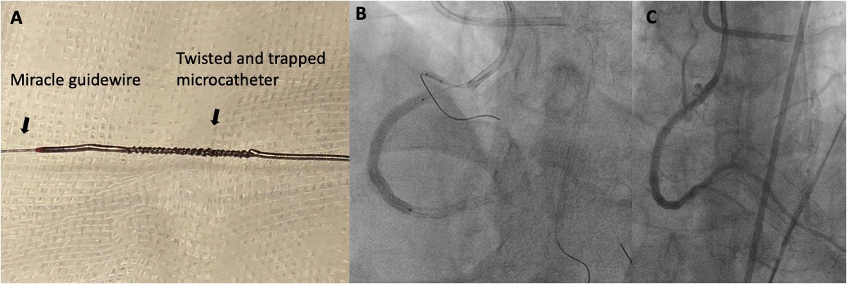 Figure 3. Trapped microcatheter