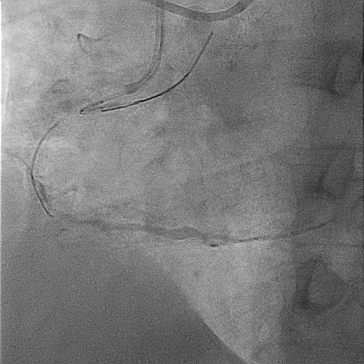 Figure 2. Wire in extraplaque space