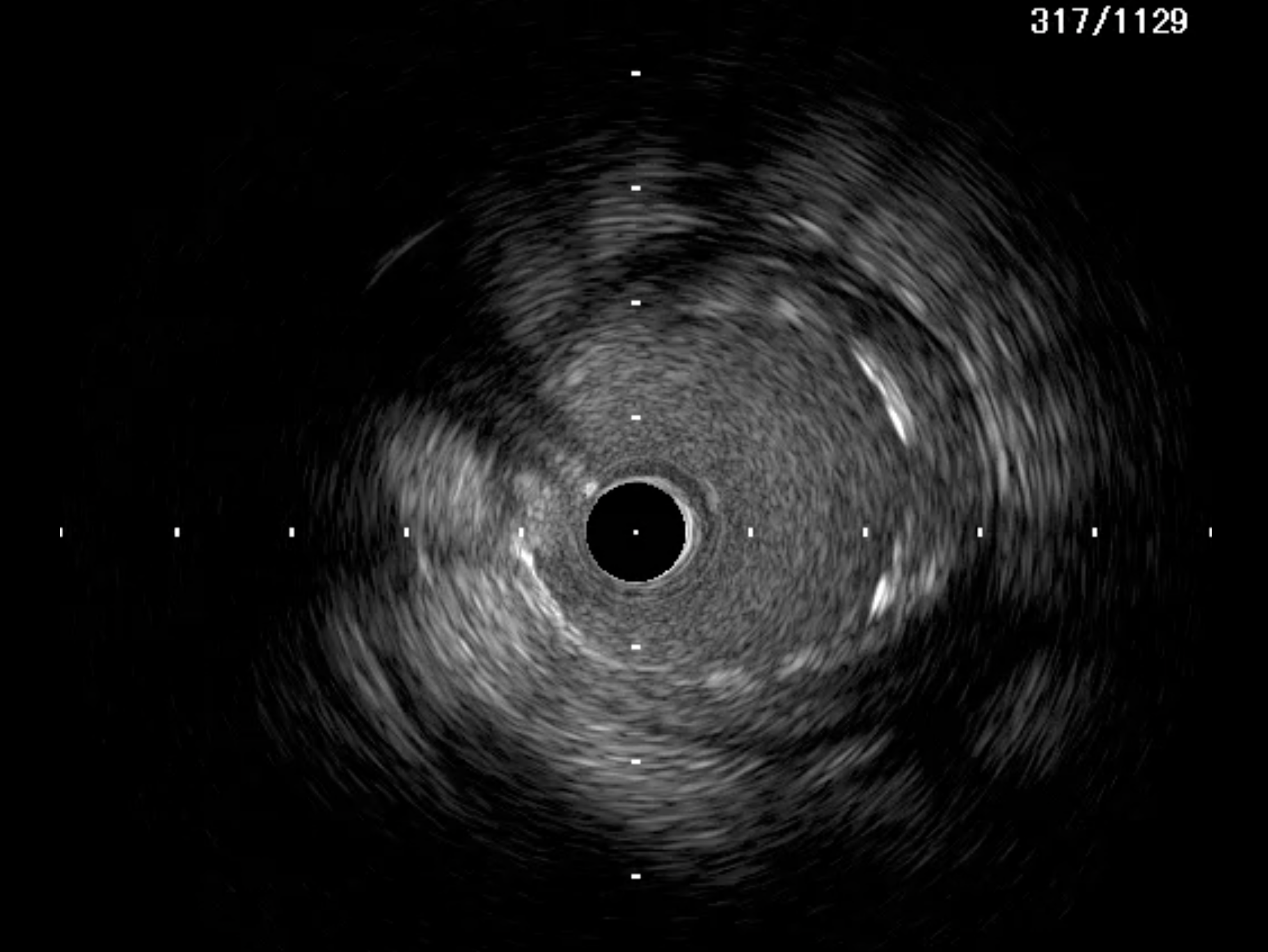 Figure 3. (B) no hematoma after stenting
