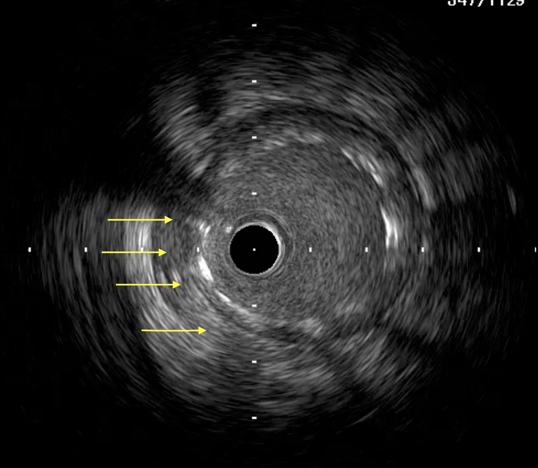 Figure 3C. small residual hematoma after stent (yellow arrows).