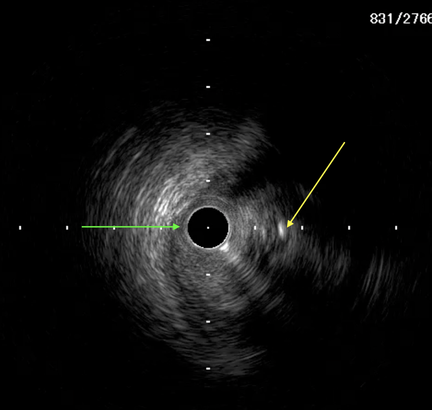 Figure 4B. IVUS in extraplaque space