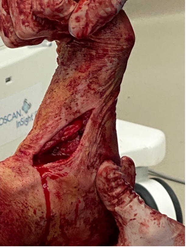 Talonavicular joint reduction