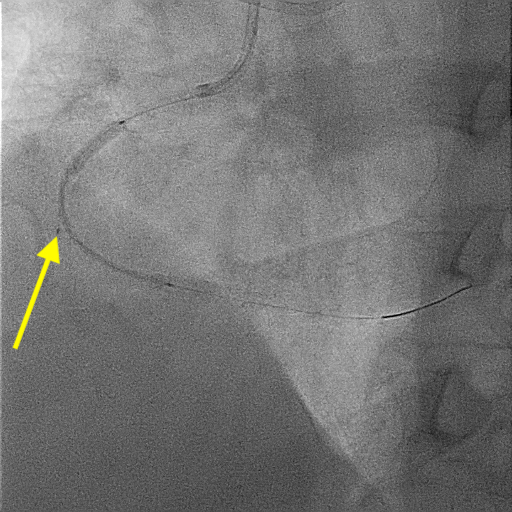 Figure 5.  Extraplaque blood withdrawal stenting 