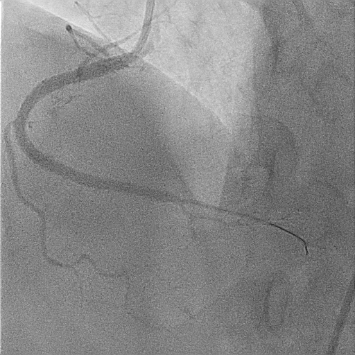 Figure 6. Final angiogram