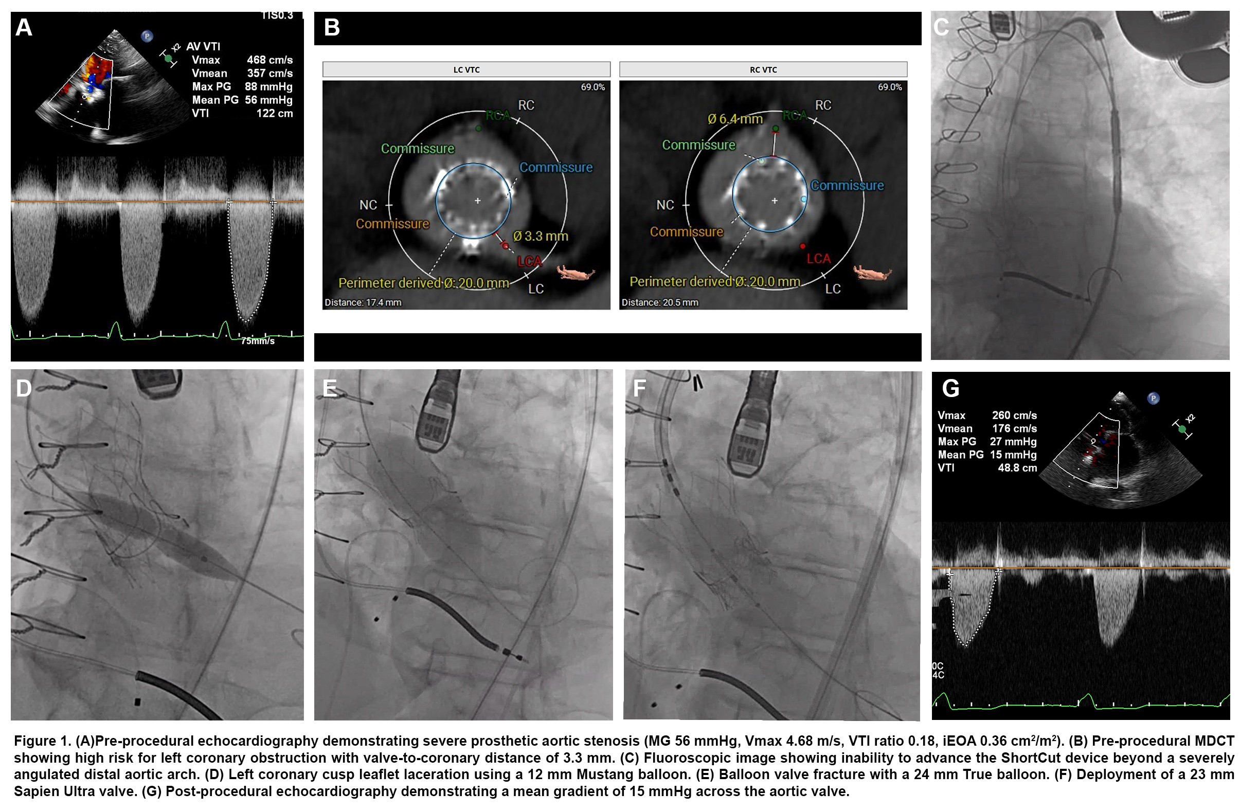 Figure 1C. Fluoroscopic image showing inability to advance the ShortCut device.