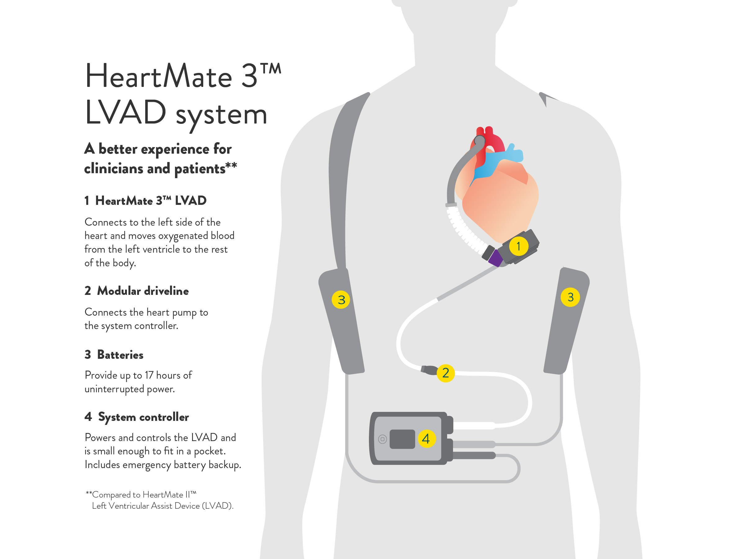 Heartmate 3 (Abbott) Illustration