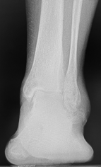 Computed tomography of the left foot showing extensive arthrosis of the subtalar joint with flattening of the posterior facet and loss of talar height posteriorly.  Note the dorsiflexed position of the talus relative to the forefoot