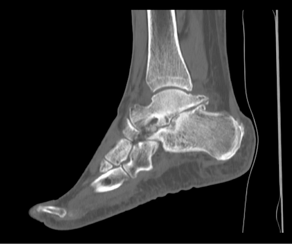 ost-operative non-weightbearing radiographs show subtalar joint graft in place fixated with 6.5mm cannulated screws.  Lateral Meary’s angle measures approximately 4º.