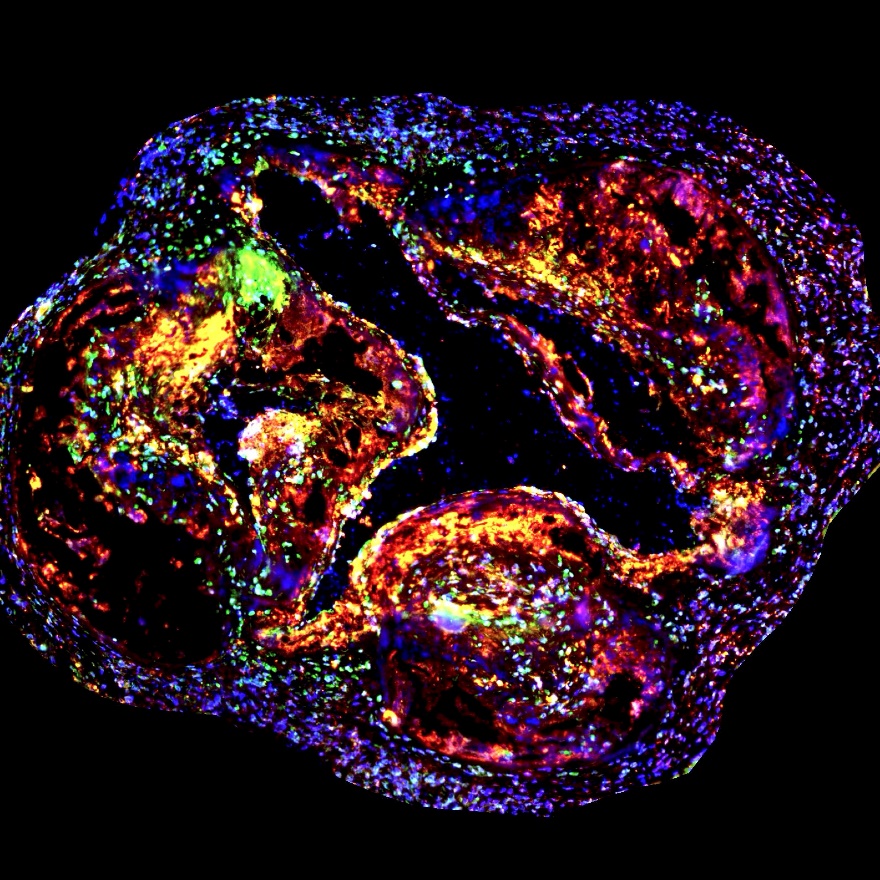 Figure: Atherosclerosis in a mouse with clonal hematopoiesis. Atherosclerotic plaques in the aorta of a mouse with immune cells that contain clonal hematopoiesis mutations. Inflammatory proteins are labeled in red and yellow. Credit: Mount Sinai Health System.