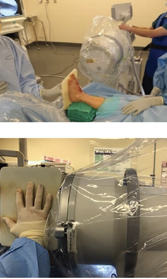 For intraoperative simulated weightbearing lateral imaging, one places the extremity in close proximity to the image intensifier to create a wide field of view (top). The bottom image demonstrates internal knee rotation to ensure a proper lateral view.