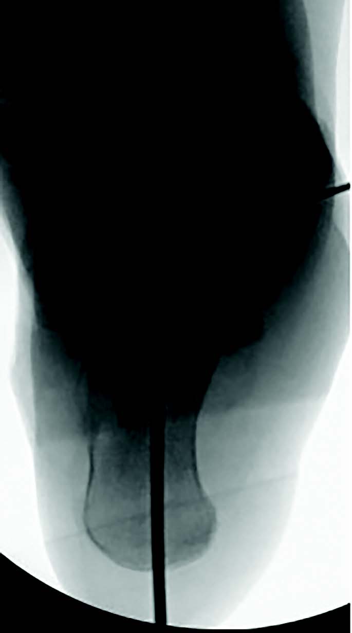 These images above show simulated weight-bearing intraoperative long leg axial imaging, which requires specific patient and imager positioning. In our practice, we attempt to image the second metatarsal through the tibia for reproducible and consistent results.