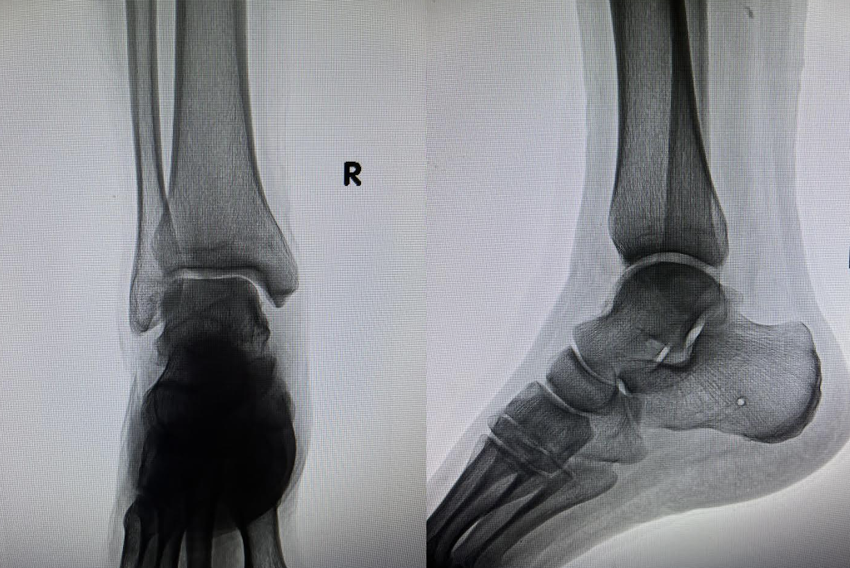  X-ray of the right ankle at initial patient presentation. AP (A) and lateral (B) show negative radiographic demonstration of acute osseous abnormality.&nbsp;