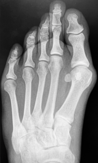 Figure 1. Pre-operative evaluation of an adult hallux valgus deformity and an elongated second ray causing metatarsalgia- type pain.