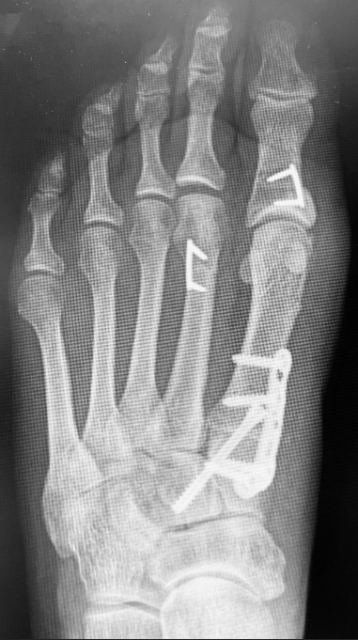 Figure 2. Post-operative X-ray displaying hallux valgus correction and an inline shortening with single staple fixation.