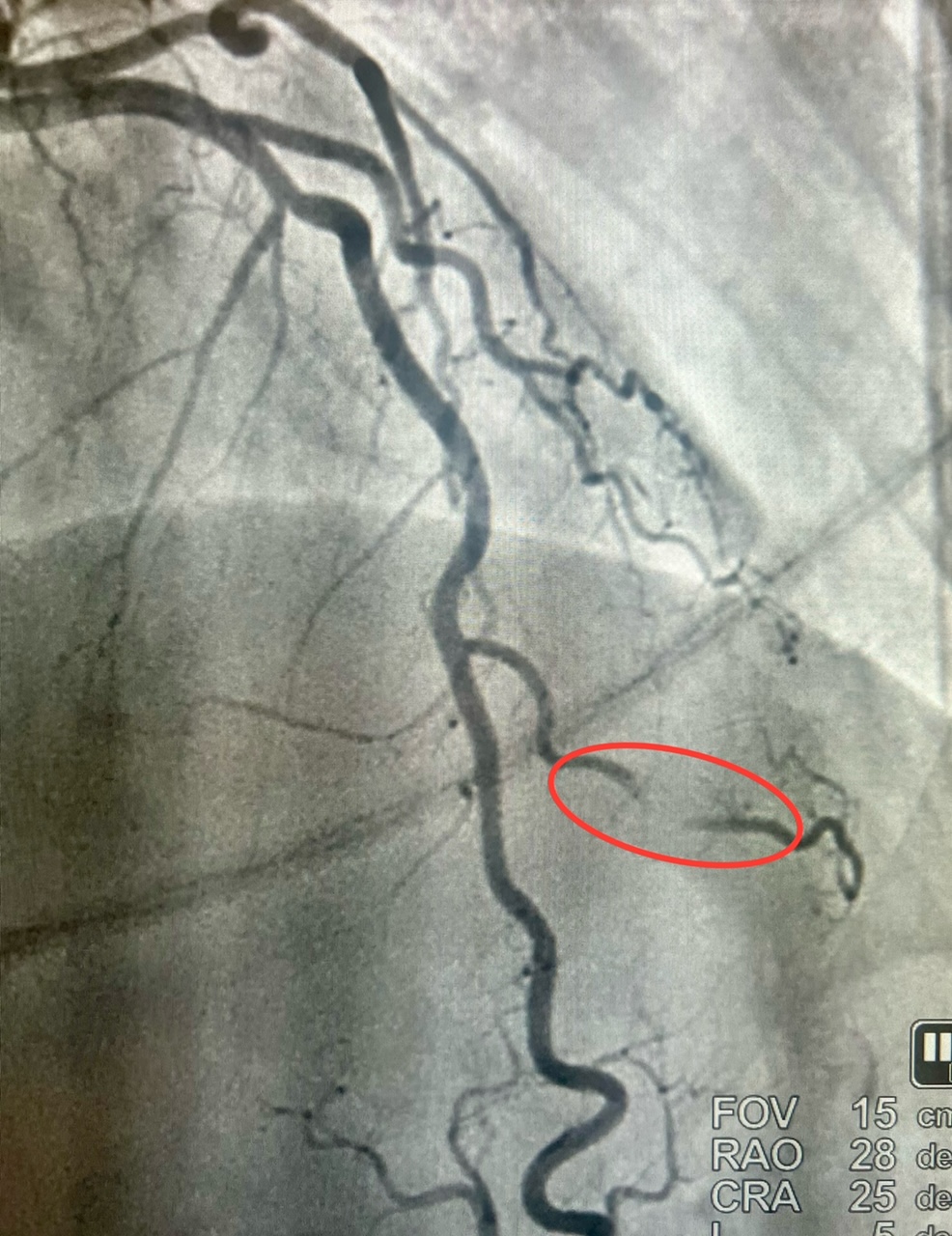 Figure 1. “Milking” during systole.