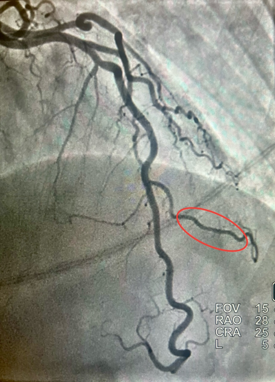 Figure 2. Diastolic phase.