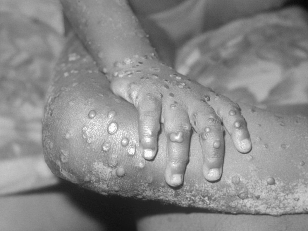 Monkeypox lesions on a Liberian child in the 1970s