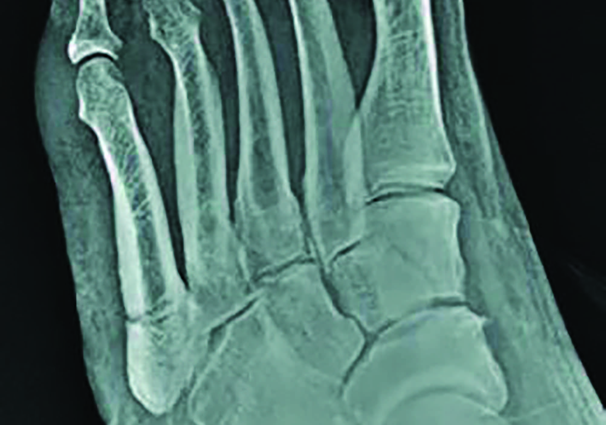 Fifth metatarsal fracture