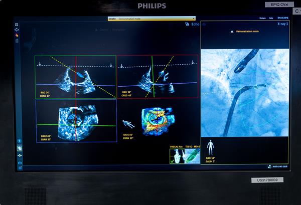Philips DeviceGuide with EchoNavigator 5 Screen