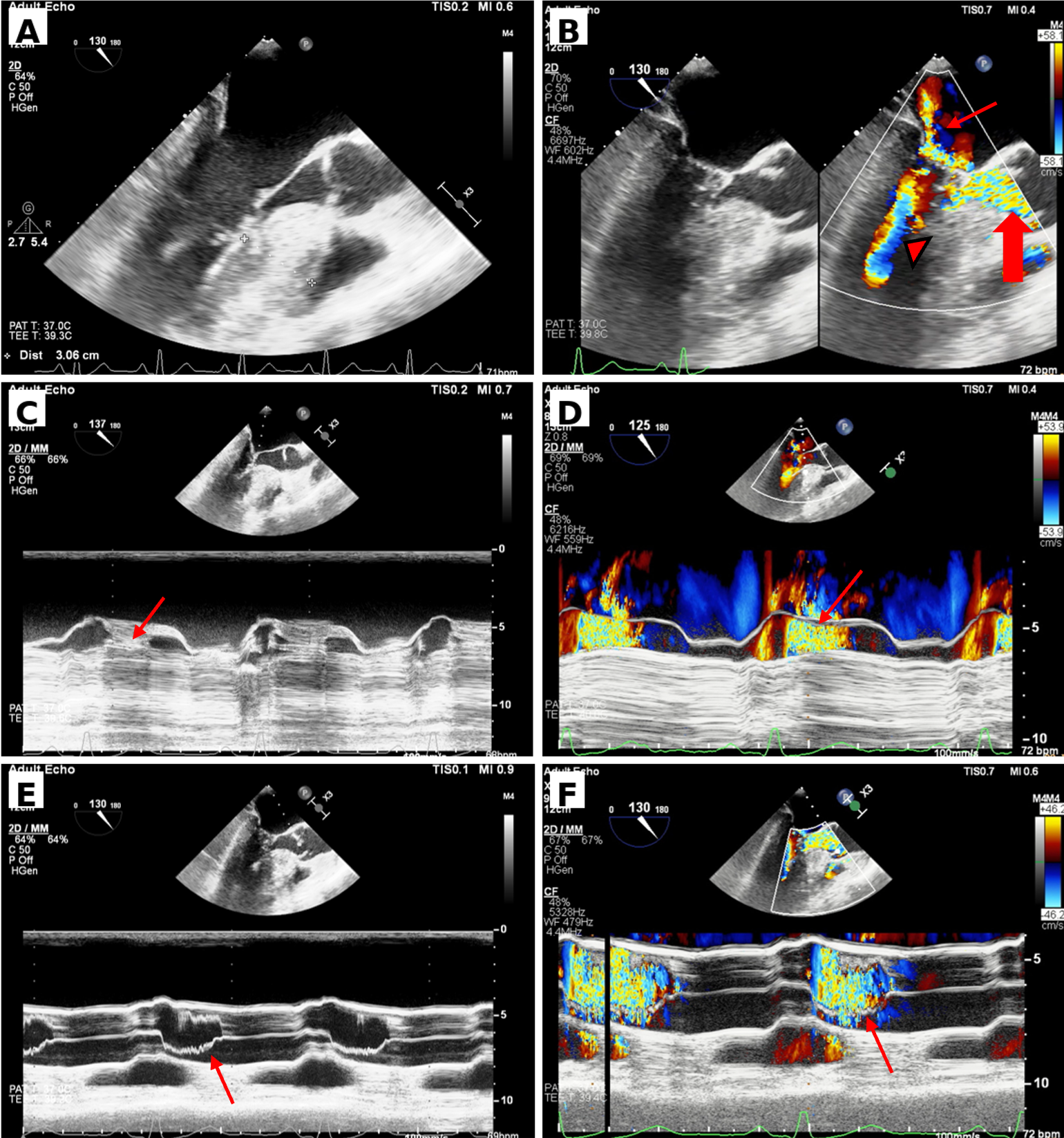 Singh-Figure-Marked-asymmetric-septal-hypertrophy