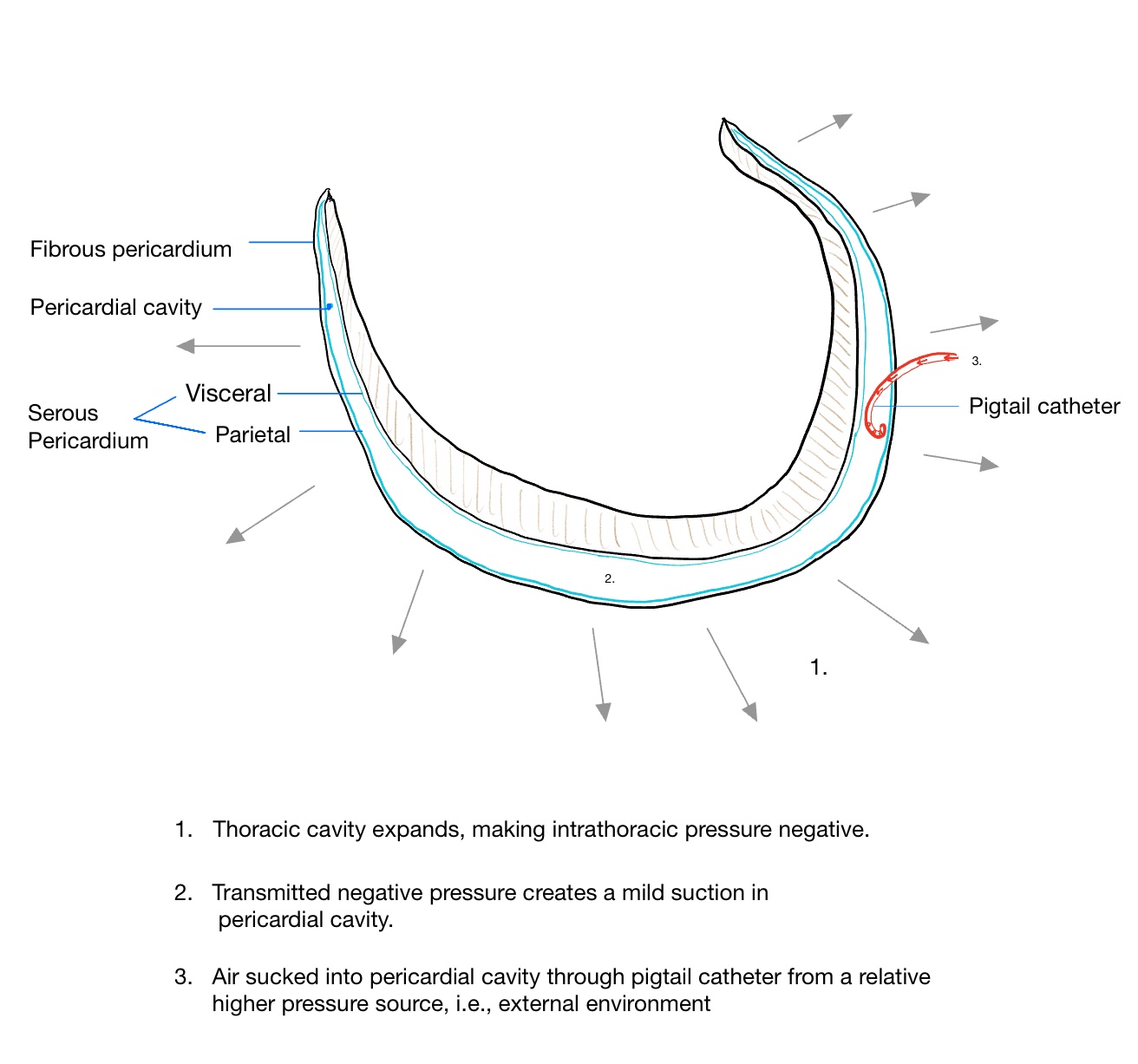 Figure 1. Mechanism of pneumopericardium during pericardiocentesis