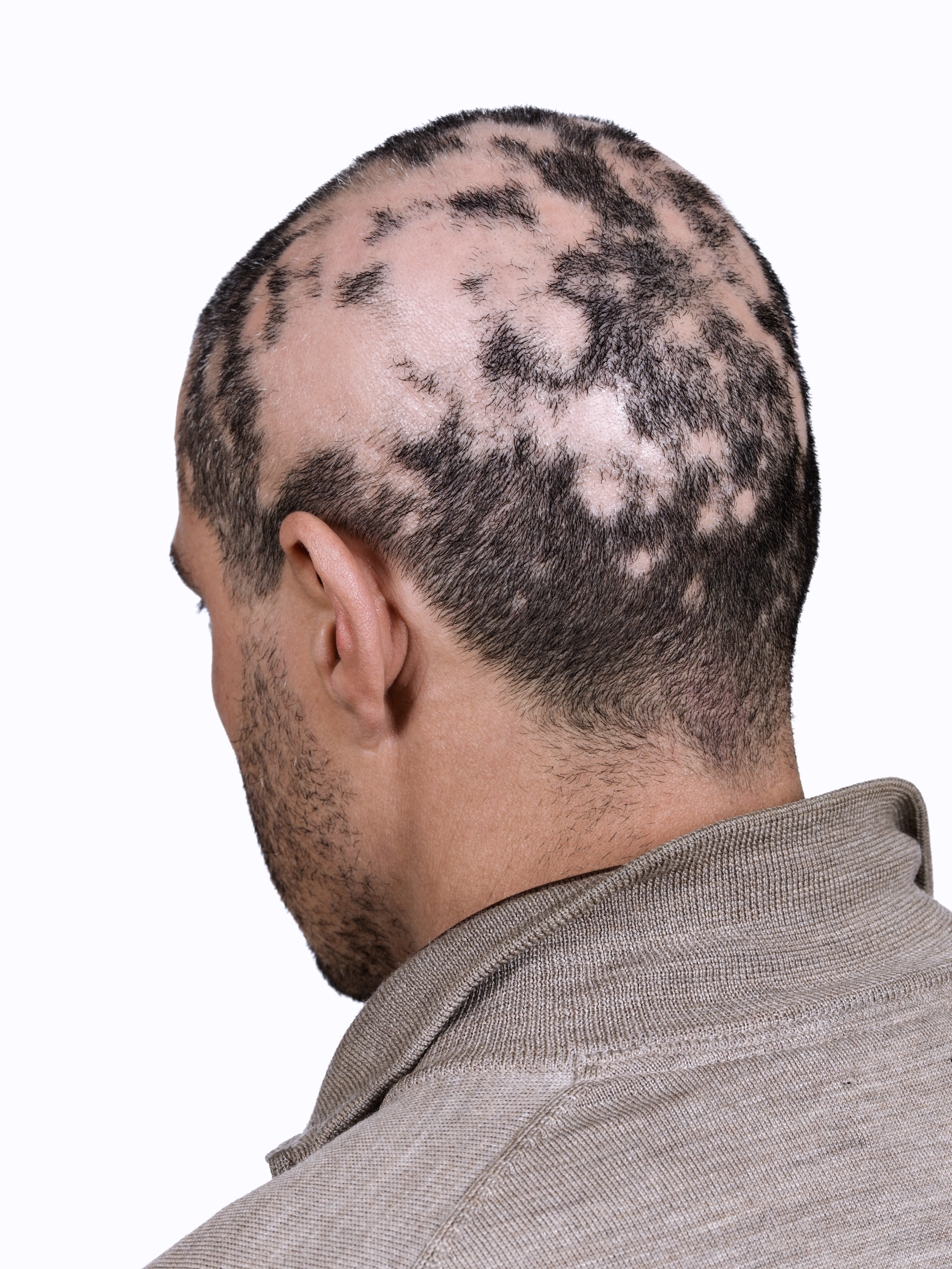 Alopecia