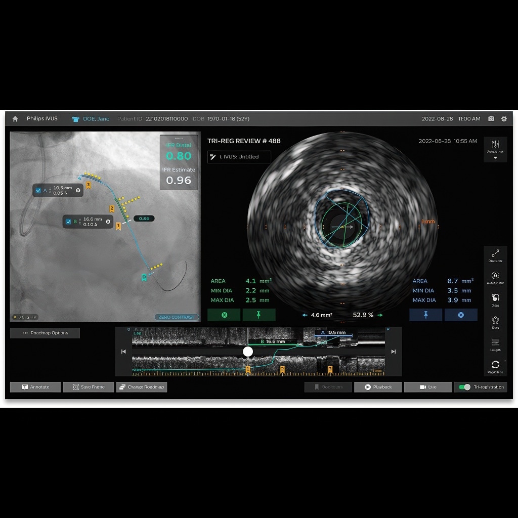 Philips IntraSight Plus screen
