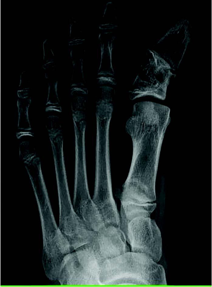 In this radiograph, one can see the left foot of the patient described in the photo above.. 