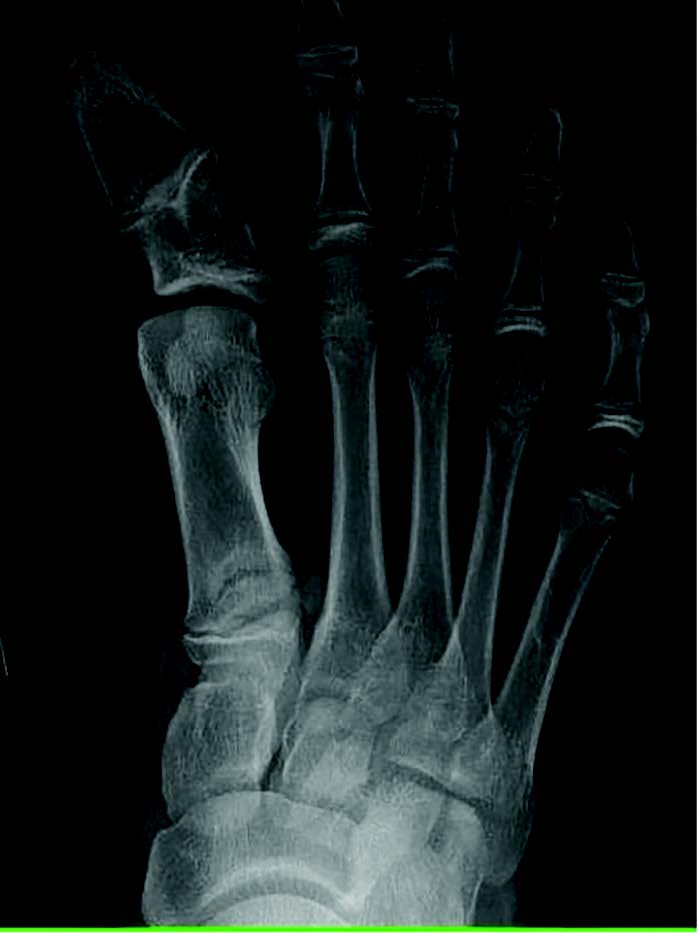 In this radiograph, one can see the right foot of the patient described in the image above.