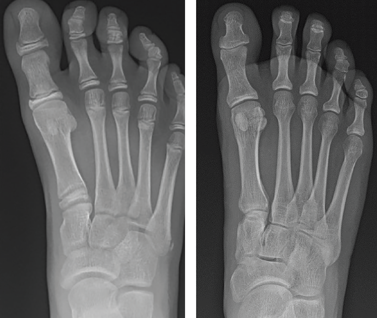 In this radiographic image, one can see early development of hallux varus in a pediatric patient, which can develop at varying ages.