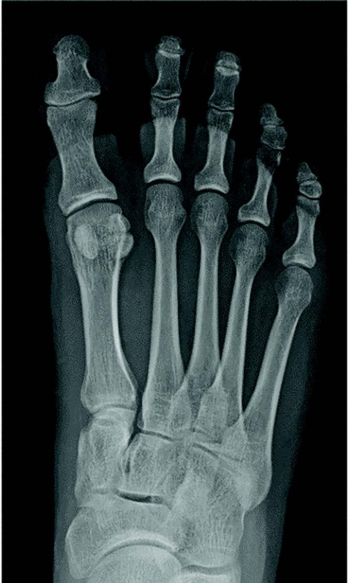 This X-ray shows a case of hallux varus with a concomitant bipartite sesamoid.