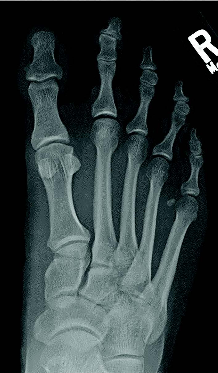 This X-ray shows a case of hallux varus where sesamoid position is well-aligned.