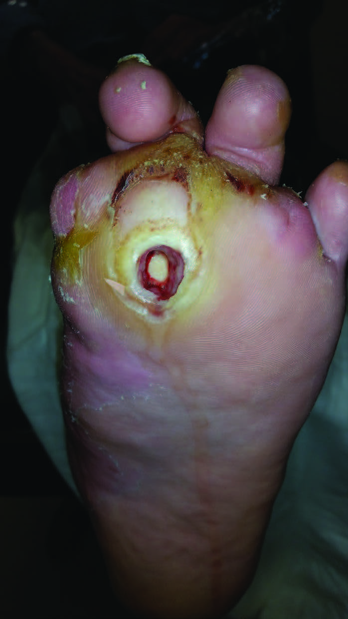 Barbara Aung, DPM, DABPM shares that implementation costs along with reimbursement challenges are two roadblocks that providers may face when trying to adopt such innovative technologies in their practices for patients with chronic wounds, as seen here.