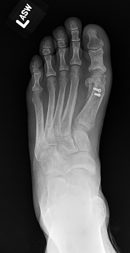 Postoperative anterior posterior foot radiograph demonstrating correction of intermetatarsal angle