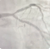 Final angiogram of LCX with optimal stent expansion.