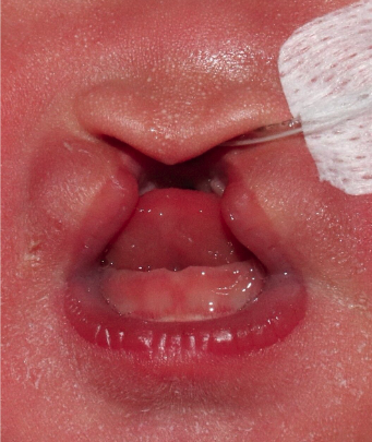 c flap cleft lip Unilateral cleft lip repair main image 0