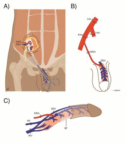 does bpc 157 help repair penis blood vessels Penile Revascularization for Erectile Dysfunction Secondary to Arterial Insufficiency: A Case Series b12 and mic injections
