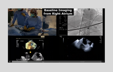 Western AFib Live Case 9