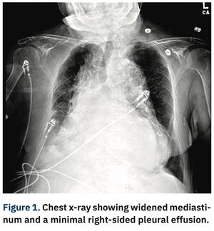 Shah Aortic Aneurysm thumbnail