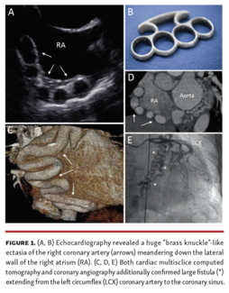 Echocardiography revealed a huge “brass knuckle”-like ectasia