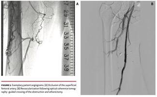 Exemplary patient angiograms.