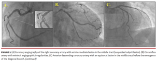 Coronary angiography of the right coronary artery