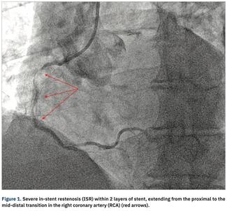 Nagaraja Orbital Atherectomy thumbnail