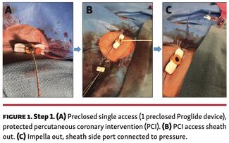 Dry Field Closure of Large-Bore Access With Iliac Artery Angioplasty Through the Ipsilateral Sheath: The Single-Access Dry-Closure Technique