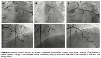  Representative examples of primary and secondary intravascular lithotripsy (IVL) treatment groups. Primary IVL group: (A) calcific lesion at baseline; (B) post IVL therapy; (C) final result after stenting. Secondary IVL group: (D) calcific lesion at baseline; (E) post IVL therapy; (F) final result after stenting (arrows).